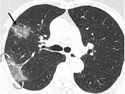 Inggris Umumkan Satu Pasien Meninggal Dunia Akibat Corona
