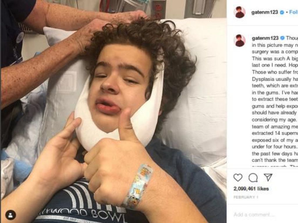 Dustin Stranger Things Alami Kelainan Cleidocranial Dysplasia, Apa Itu? Dustin Stranger Things Alami Kelainan Cleidocranial Dysplasia, Apa Itu?