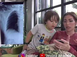 Jadi Korban Tabrak Lari, 5 Tulang Rusuk Ayah Jessica Iskandar Patah