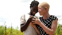 Kehidupan Anak Albino di Afrika yang Selalu Diliputi Kecemasan
