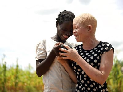Kehidupan Anak Albino di Afrika yang Selalu Diliputi Kecemasan