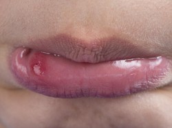 Benarkah Kurang Vitamin C Bikin Sering Sariawan? Dokter Ungkap Faktanya