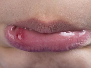 Benarkah Kurang Vitamin C Bikin Sering Sariawan? Dokter Ungkap Faktanya Benarkah Kurang Vitamin C Bikin Sering Sariawan? Dokter Ungkap Faktanya