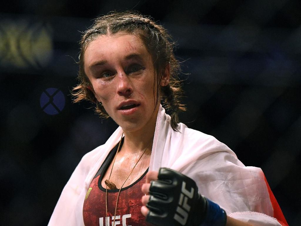 Wanita yang Kepalanya Pernah Penyok Usai Tanding UFC, Begini Kondisinya Kini Wanita yang Kepalanya Pernah Penyok Usai Tanding UFC, Begini Kondisinya Kini