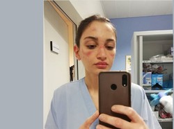 Perawat Cantik Pamerkan Wajah Memar karena Masker Saat Rawat Pasien Corona