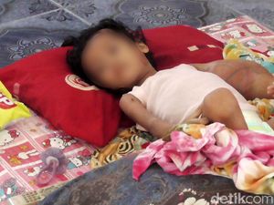 Tolong! Gadis Cilik Penderita Tumor di Polman Butuh Bantuan