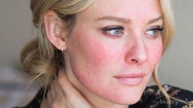 Yuk Pakai Skincare Khusus untuk Kulit Kemerahan Berikut, Ladies!