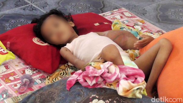 Balita di Polman Ini Terbaring Lemah Akibat Tumor Ganas