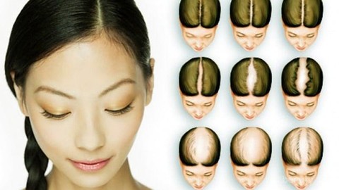 Obat rambut rontok parah pada wanita