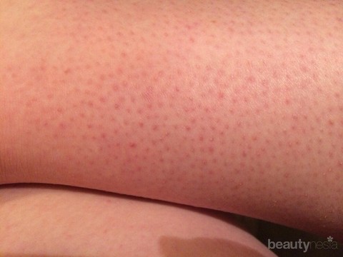 Tips Alami Untuk Menghilangkan Bintik Bintik Hitam Di Kaki Strawberry Legs