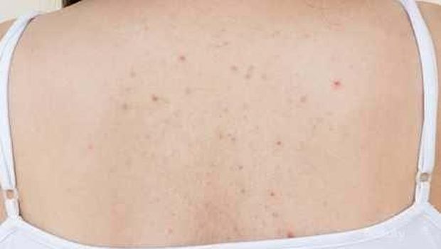 Jerawat di Punggung Mengganggu? Bisa Kamu Hilangkan dengan Bahan Alami Ini