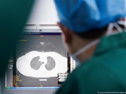 Jalani Transplantasi, Ini Potret Kerusakan Paru-paru Wanita karena Corona