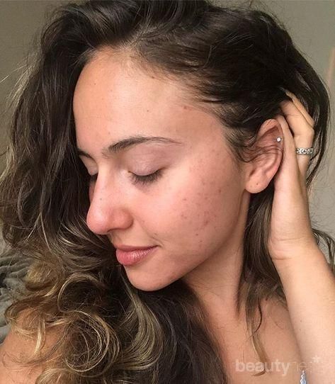 Ini Bedanya Freckles dan Flek Hitam, Cari Tahu Yuk!