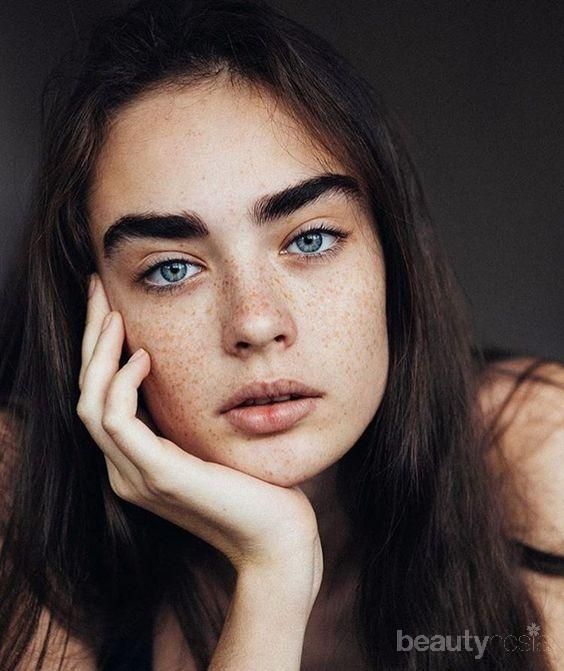 Ini Bedanya Freckles dan Flek Hitam, Cari Tahu Yuk!