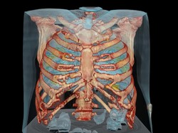 Dari Minim Gejala Sampai Meradang, Ini Gambar Paru-paru Pasien Corona