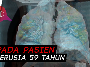 Ini Penampakan Paru-paru yang Terserang COVID-19