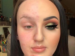 Hanya Pakai 3 Produk, Wajah Berjerawat Wanita Ini Jadi Super Flawless