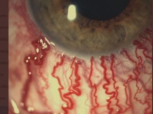 Viral Penampakan dari Dekat Mata Memerah Akibat Menangis, Ini Kata Dokter