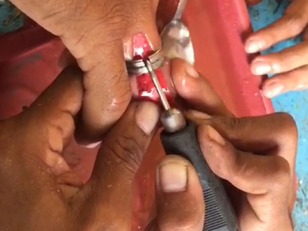 Damkar Ciamis Potong Cincin Nyangkut 3 Hari di Jari Kuli Bangunan Damkar Ciamis Potong Cincin Nyangkut 3 Hari di Jari Kuli Bangunan