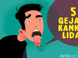 5 Gejala Kanker Lidah, Mati Rasa hingga Sariawan Tak Sembuh-sembuh