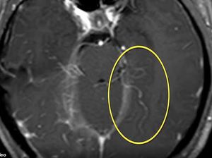 Hobi Makan Daging Mentah, Otak Wanita Ini Dipenuhi Cacing Hidup