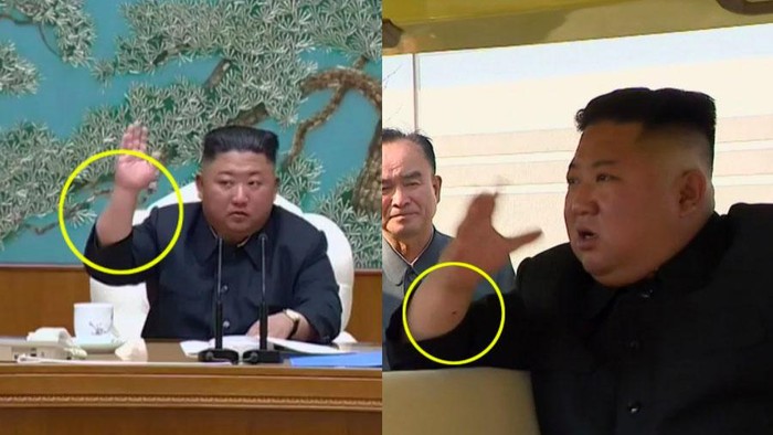 kim jong un bekas operasi