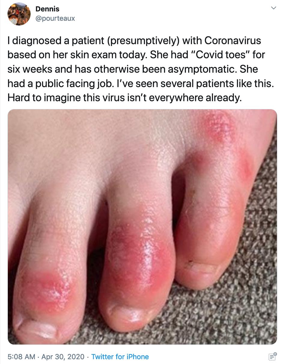 Covid toes