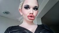 Foto Before-After Wanita Obsesi Punya Bibir Terbesar di Dunia, Dulu Lebih Cantik