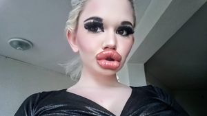 Foto Before-After Wanita Obsesi Punya Bibir Terbesar di Dunia, Dulu Lebih Cantik