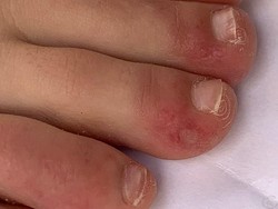 Pakar Terkejut Melihat Ruam Kulit pada Pasien COVID-19, Gejala Baru Corona?