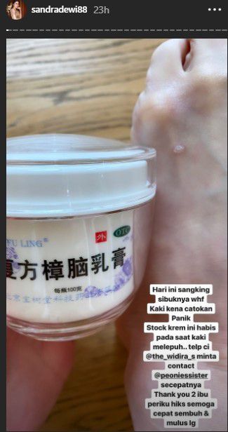 Kaki Sandra Dewi melepuh