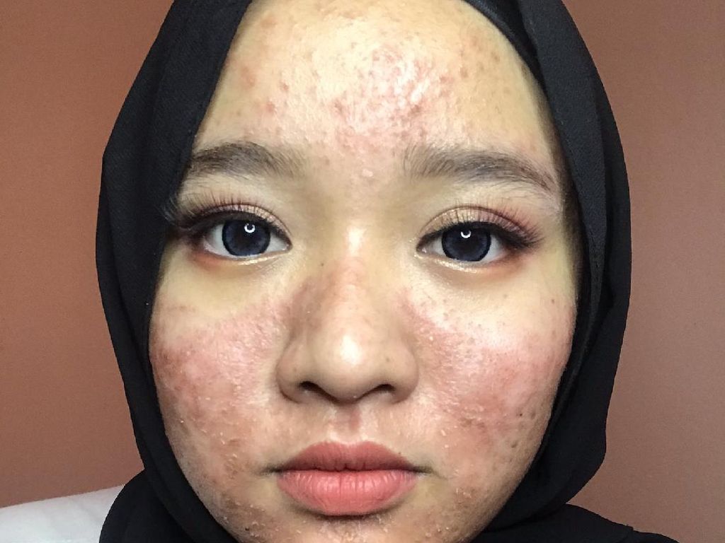 Wanita Ini Percaya Diri Tampil Berjerawat Parah di Media Sosial Wanita Ini Percaya Diri Tampil Berjerawat Parah di Media Sosial