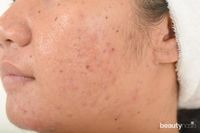 Menghilangkan Acne Scars Gak Boleh Sembarangan, Ini Yang Harus Kamu ...