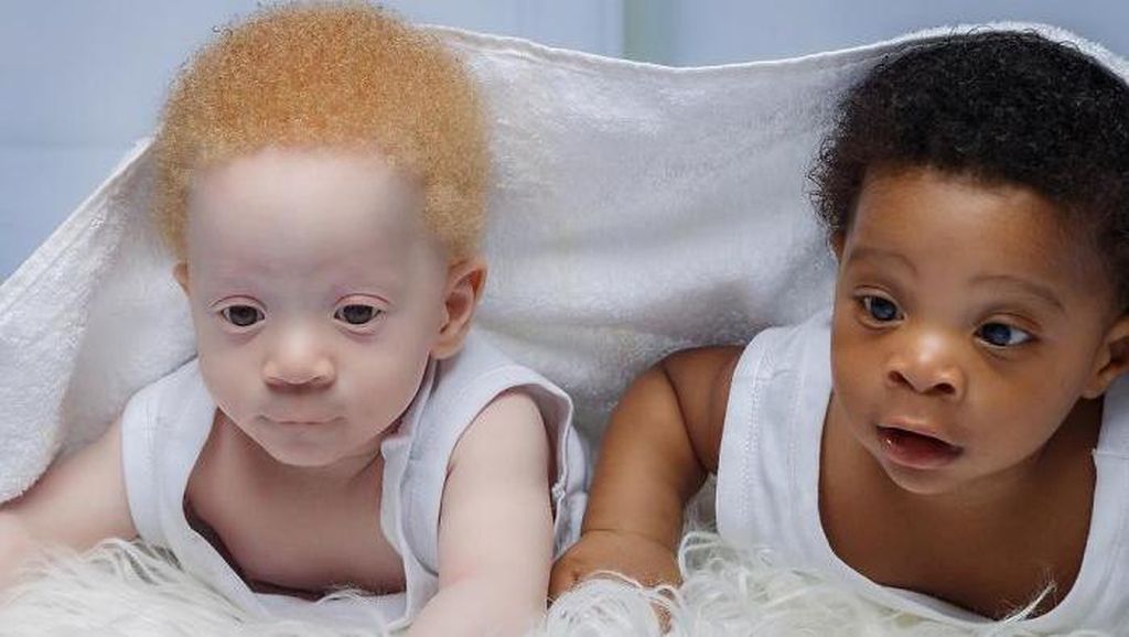 Potret Bayi Kembar yang Terlahir Beda Warna Kulit