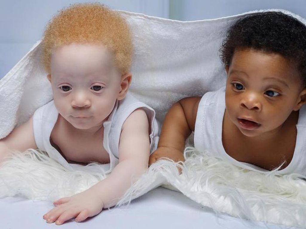 Potret Bayi Kembar yang Terlahir Beda Warna Kulit Potret Bayi Kembar yang Terlahir Beda Warna Kulit