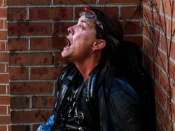 Ditembak Peluru Karet Saat Demo George Floyd, Seorang Wartawan Buta Permanen