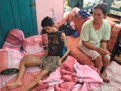 Cerita Pilu Sopian Idap Tumor Sebesar Bola Sepak di Pahanya