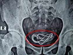 Mengejutkan! Kabel Charger Bersarang di Kandung Kemih Pria Ini