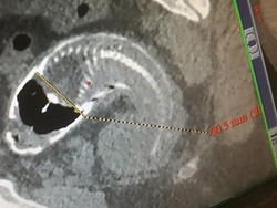 Duh! Ikan Nyangkut di Dubur Pria Ini Gegara Tak Sengaja Diduduki