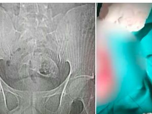 Wadaw! Ada Ikan Nila Nyangkut di Bokong Pria Ini Wadaw! Ada Ikan Nila Nyangkut di Bokong Pria Ini