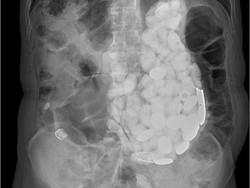 Bikin Takjub! Ada Perhiasan hingga Tutup Botol dalam Perut Manusia