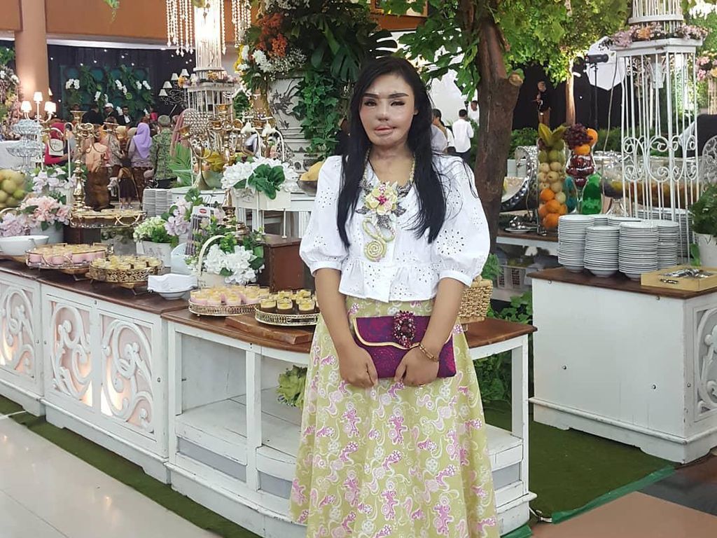 Kisah Inspiratif Wanita Surabaya, Dulu Disiram Suami Air Keras Kini Sukses