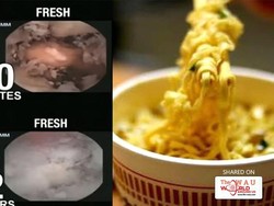 Begini Proses Pencernaan Mie Instan dalam Perut Manusia