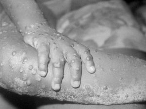 Diberantas dalam Waktu 200 Tahun, Apa yang Bisa Dipelajari dari Cacar?