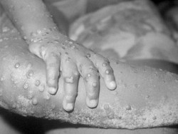 Diberantas dalam Waktu 200 Tahun, Apa yang Bisa Dipelajari dari Cacar?