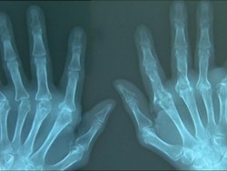 Kasus Penyakit Autoimun Meningkat Drastis di Jerman