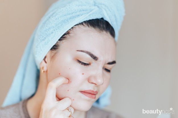 Penyebab Jerawat Gatal