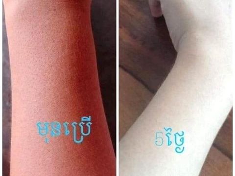 Perbedaab sebelum dan setelah menggunakan krim pemutih