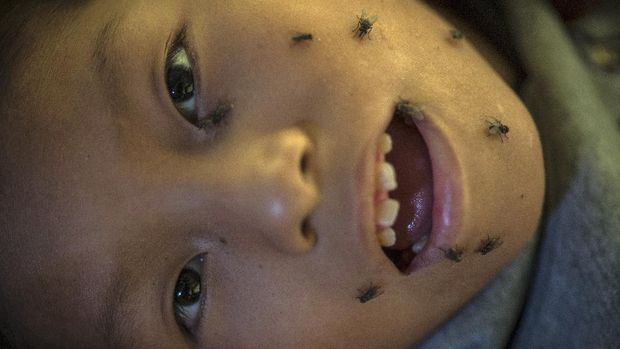 11-year-old David Leandro Del Aguila, unable to swat away the flies on his face because he is quadriplegic, eyes the camera while lying on a bed in his home in the Nueva Esperanza neighborhood of Lima, Peru, Tuesday, June 9, 2020. Quarantines and shutdowns meant to slow the spread of the new coronavirus have left millions of poor people with no way to feed their families. (AP Photo/Rodrigo Abd)
