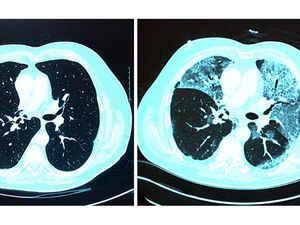Ribuan Orang Mantan Pasien Corona Terancam Gangguan Fibrosis Paru